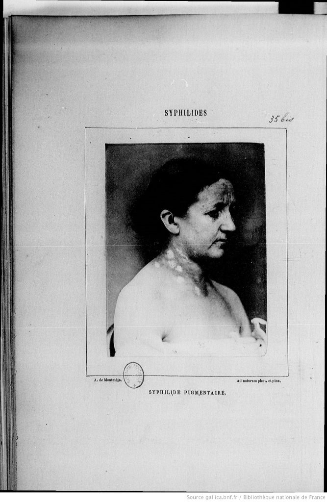 A portrait photograph of a woman with a spotted neck and a black scarred forehead. On top of the frame is marked "Syphilides"; syphilis.