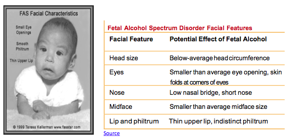 The facial features of a baby with Fetal Alcohol Spectrum Disorder: Small eye openings, Smooth philtrum, and Thin upper lip.