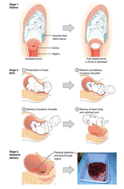 Vaginal delivery involves 3 stages. Stage 1: Dilation of the cervix. Stage 2: Presentation of head, rotation and delivery of anterior shoulder, delivery of posterior shoulder, and delivery of lower body and umbilical cord. Stage 3: Anfterbirth delivery when the placenta detaches and exits through vagina.