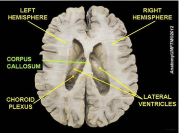 Illustration of the two hemispheres of a half-brain with arrows showing the left hemisphere, corpus callosum, choroid plexus, right hemisphere, and lateral ventricles