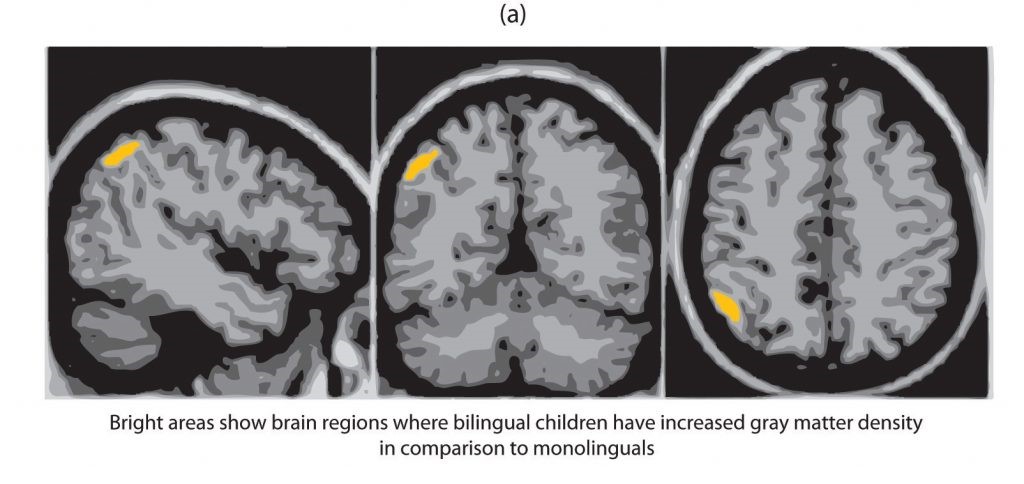 A brain scan showing three views of a brain, each with a small bright yellow spot. The bright areas show brain regions where bilingual children have increased gray matter density in comparison to monolinguals.