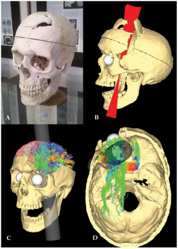 Image (a) is a photograph of Phineas Gage holding a metal rod. Image (b) is an illustration of a skull with a metal rod passing through it from the cheek area to the top of the skull. Image described in caption.
