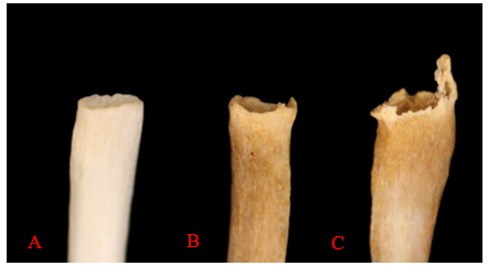 Three sternal rib ends demonstrating progressive changes that occur with age.